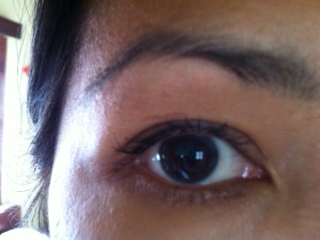 Eye scar from KR torture 34 years ago, 25 July 2011